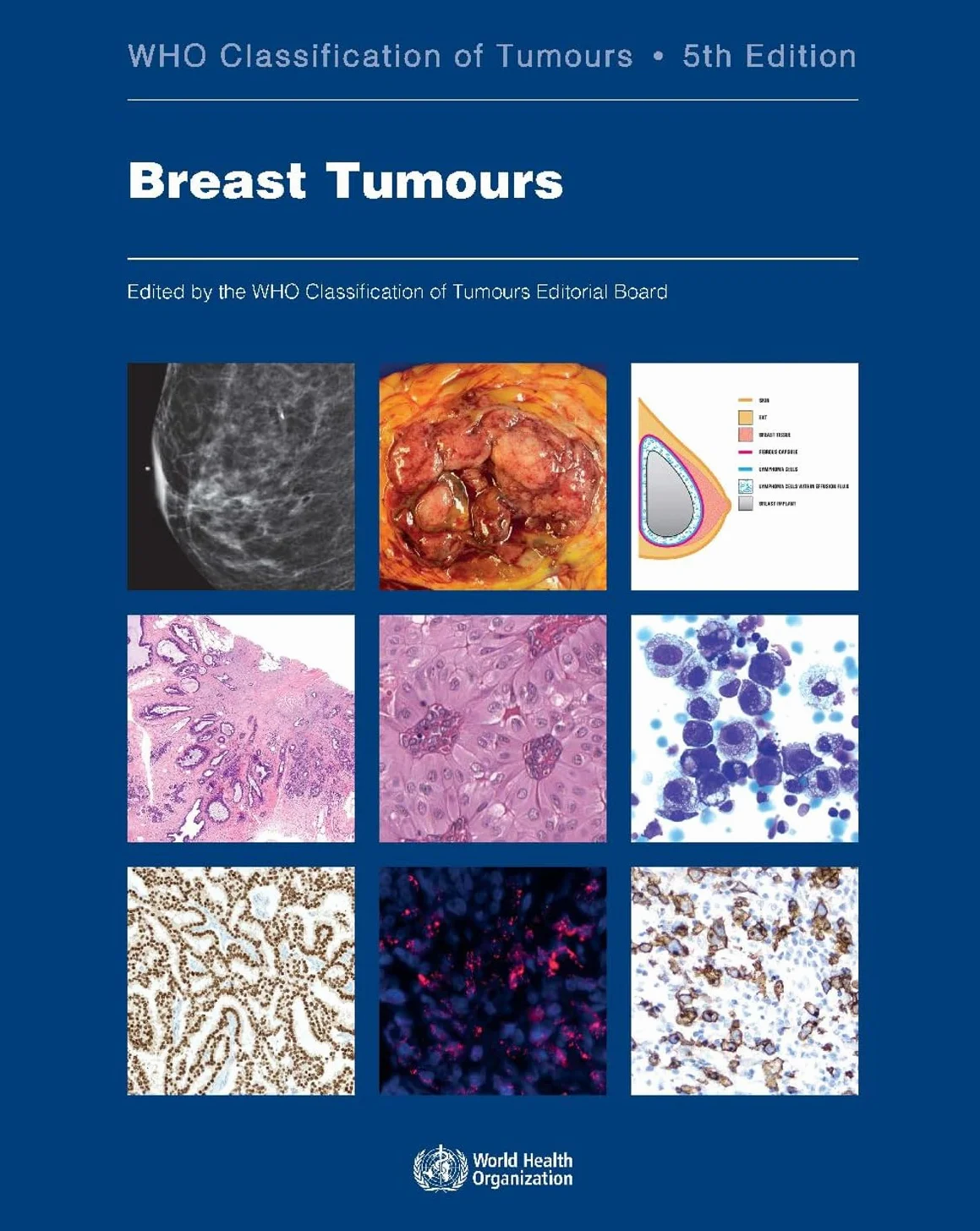 WHO Classification of Breast Tumours: WHO Classification of Tumours, Volume 2 (World Health Organization Classification of Tumours)